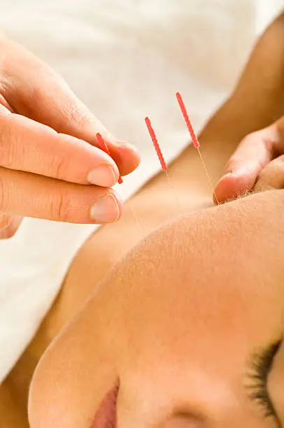 鍼灸ってどんなもの？（その１）